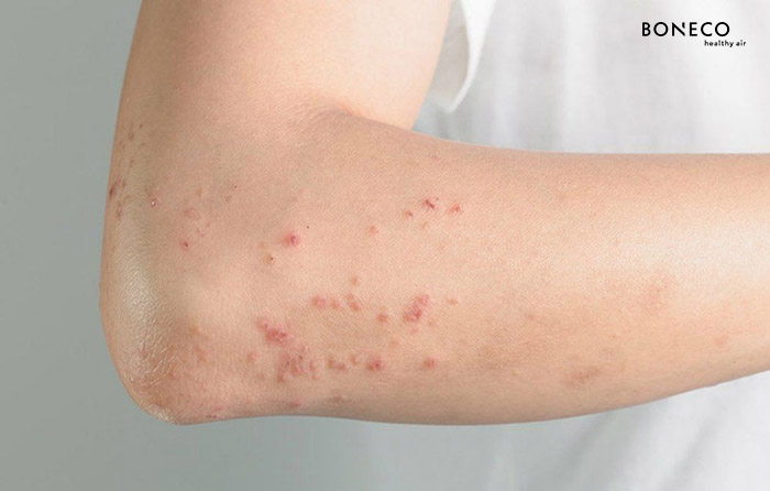 Ngoài sốt xuất huyết, còn 3 căn bệnh thường gặp mùa mưa cần đề phòng