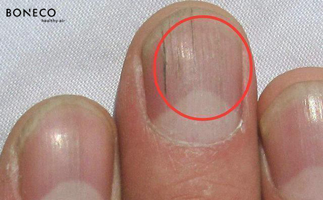 Nếu gan sinh bệnh hoặc nhiễm độc, móng tay sẽ có 3 thay đổi bất thường dễ nhận biết